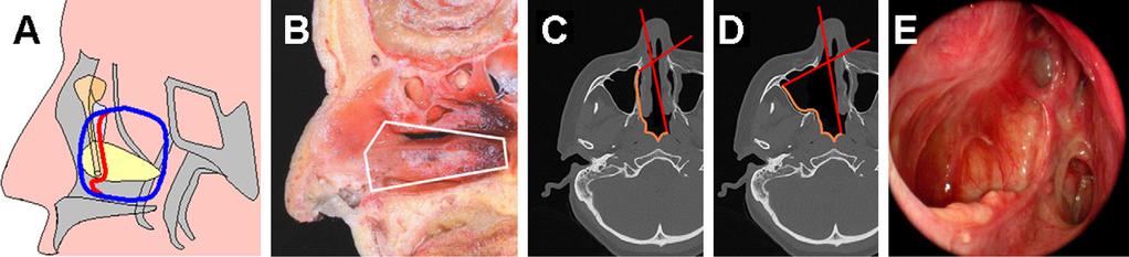 286 B. Verillaud et al. Figure 2 Medial maxillectomy. A. Diagram of the resection with section of the lacrimal duct (blue) and modified medial maxillectomy preserving the lacrimal duct (red).