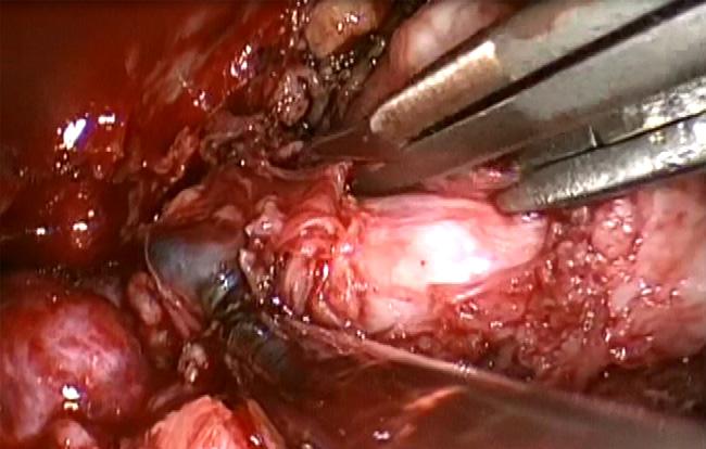 288 B. Verillaud et al. Figure 4 Endoscopic view of four-hand surgery.