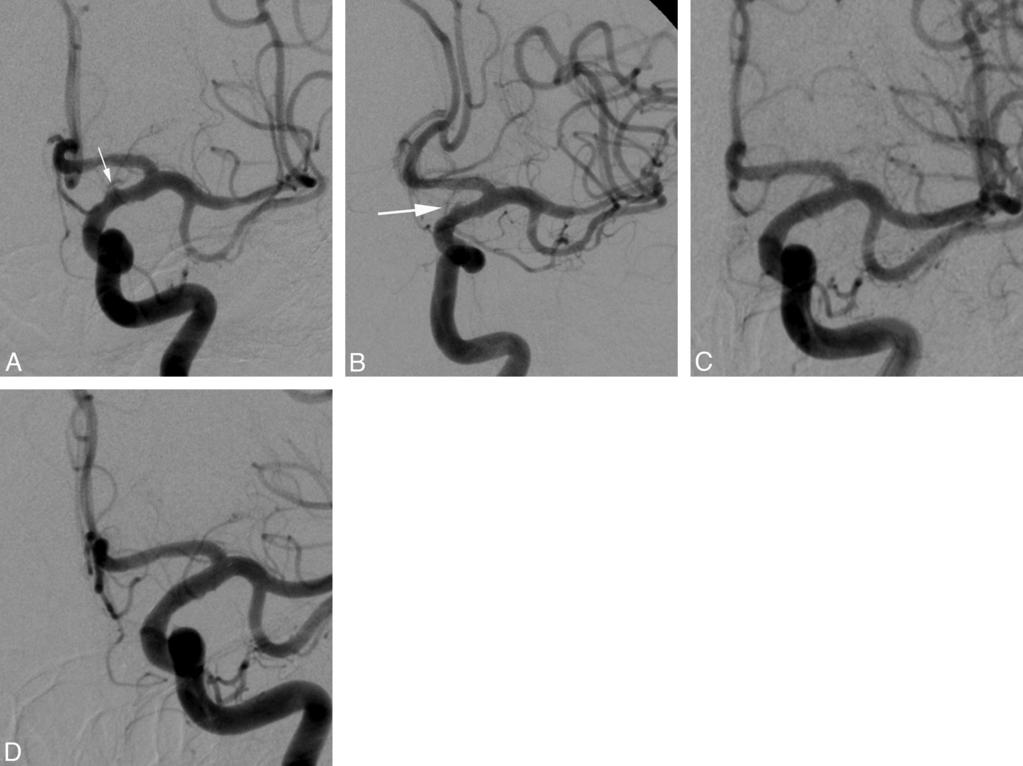 Fig 1. Left supraclinoid ICA blister aneurysm.