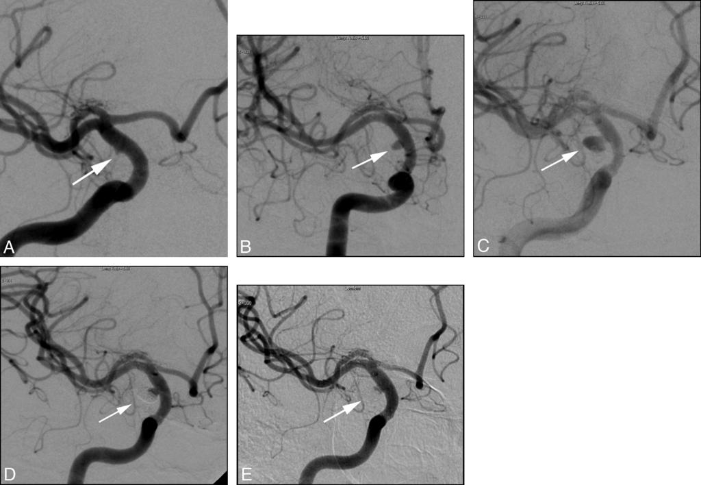 Fig 3. Right supraclinoid ICA blister aneurysm.