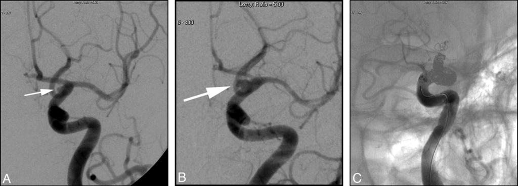 aneurysm. One-month follow-up DSA (B ) following endovascular stent placement again shows the blister aneurysm (white arrow ), now increased in size and more round in shape.
