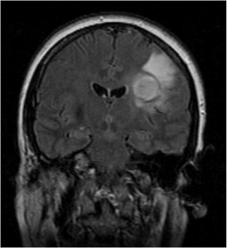 Case 2: 57 year old woman with acute onset of slurred speech 6. 05/15/15: Re-resection of left frontal tumor under ALA guidance by Dr. Mitchel Berger at UCSF.