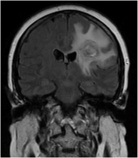 Case 2: 57 year old woman with acute onset of slurred speech She underwent biopsy of left frontal mass.
