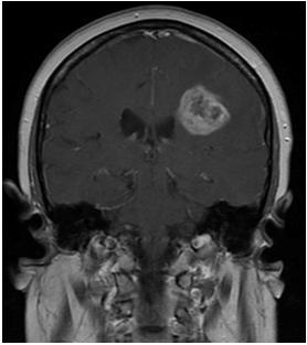 cycles of adjuvant temozolomide MRI with increased enhancement and neurologic worsening expressive aphasia and right sided weakness