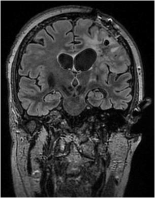06/2017 41 This recurrent high grade glioma that has recurred/progressed from a lower-grade diffuse glioma demonstrates a very high mutation burden with greater than 300 somatic nonsynonymous