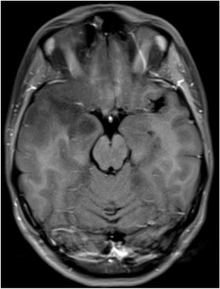 Case 1: 34 year old woman with panic attacks In 07/2015 patient presented to academic medical center with 9 years of escalating spells described as a "weird smell" followed by "fuzzing out", nausea