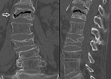 Treatment of Compression Fractures Vertebroplasty Percutaneous injection of bone cement under fluoroscopy into the collapsed vertebral body Kyphoplasty Involves an inflatable bone tamp, or balloon