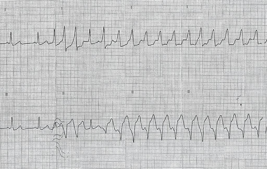 Holter ρυθμού 24ωρου The hallmark ECG features of AF in WPW include rhythm irregularity, very