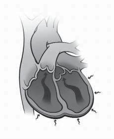 In heart failure, the weakened heart cannot pump as strongly. There are many things that can damage your heart and lead to heart failure over time.