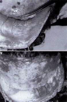 Fig1 Dissection of a cadaver, Observing the surgical planes and the thread trajectory. Fig2. Thread trajectory in medial lifting and in lateral lifting.