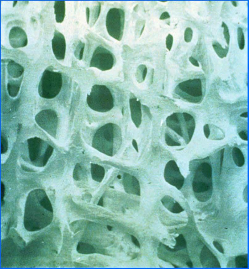 Pathogenesis of Osteoporosis &