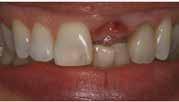 How is S1 dental placement surgery done?