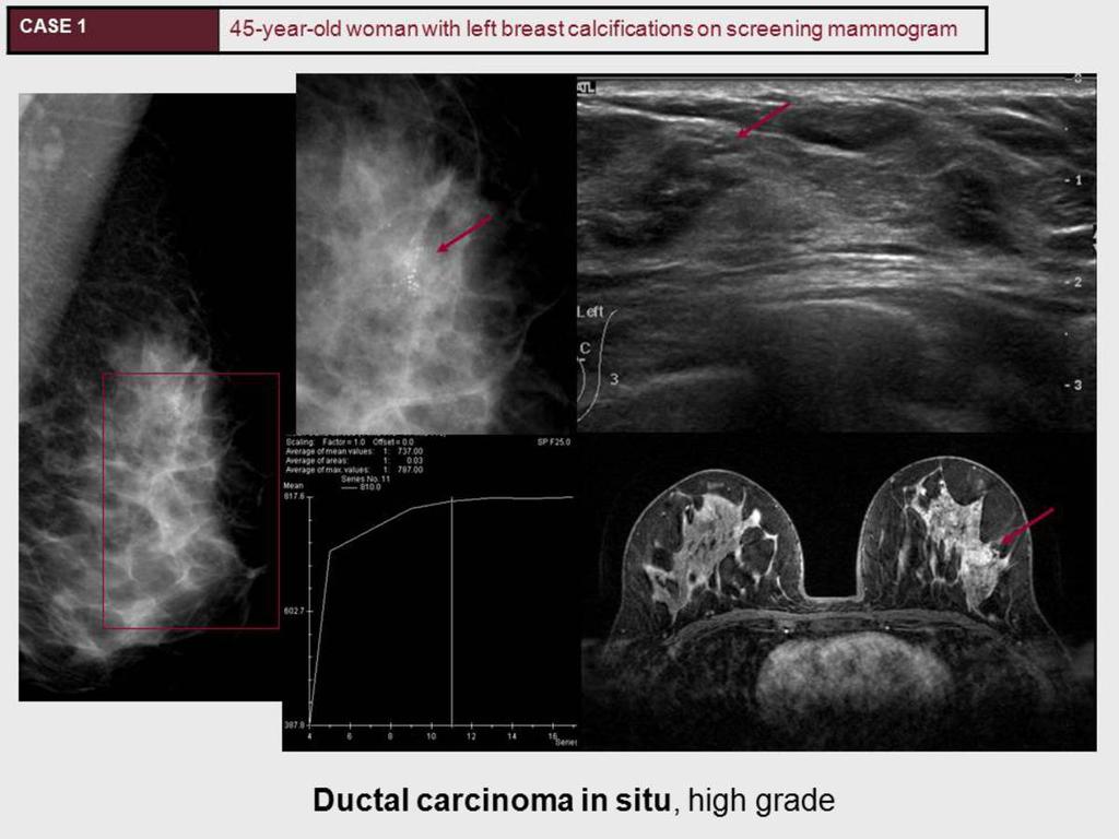Fig. 2: A 45 year-old woman was found with abnormal microcalcifications in the left breast on screening MG. The lesion was not apparent in US apart from calcific foci.