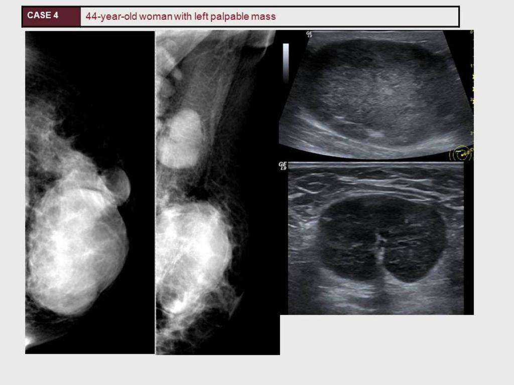 Fig. 6: A 44 year old woman with a 5cm sized large palpable mass lesion in the left breast was evaluated.
