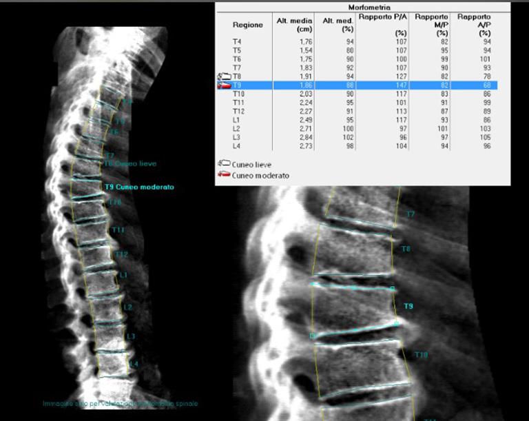 VFA, vertebral fracture assessment; DXA, dual energy X-ray absorptiometry. Figure 6 Morphometric analysis of DXA spine image with accompanying chart (on the top right).