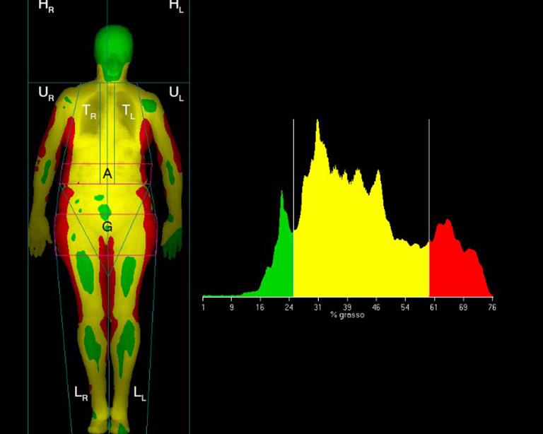 64 Guerri et al. Quantitative imaging in osteoporosis and sarcopenia Figure 2 Whole body DXA scan.