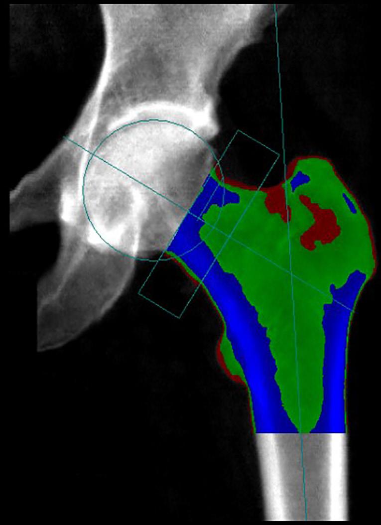 66 Guerri et al. Quantitative imaging in osteoporosis and sarcopenia Figure 4 Hip scan with hip geometry analysis.