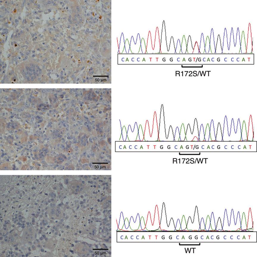 Kaneko et al. IDH2-R172S mutation in GCTB patients, which was detected by MsMab-1 mab and direct DNA sequencing. Materials and Methods Immunohistochemical analyses.