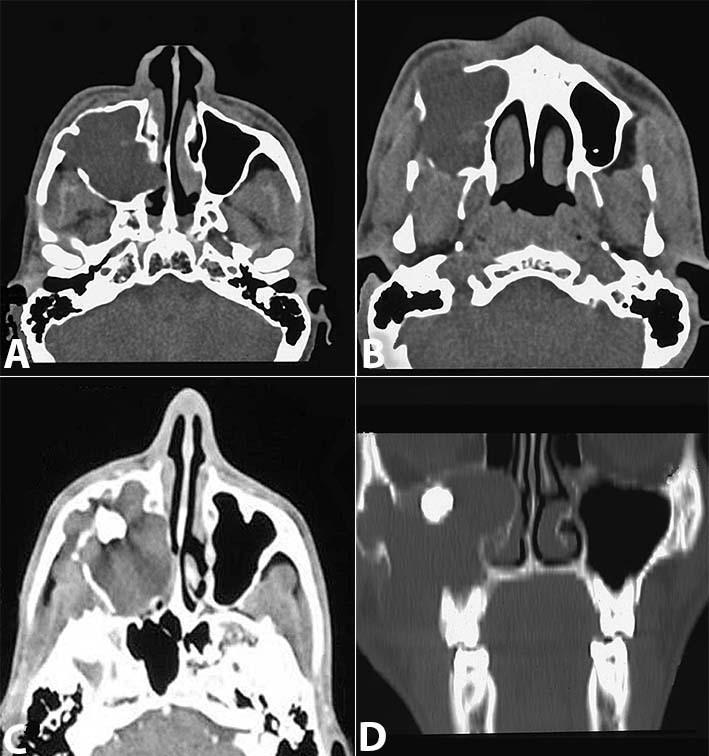 Kaushik R, Pushpanshu K, Punyani SR, Raj V Figure 2. Axial CT of the sinuses.