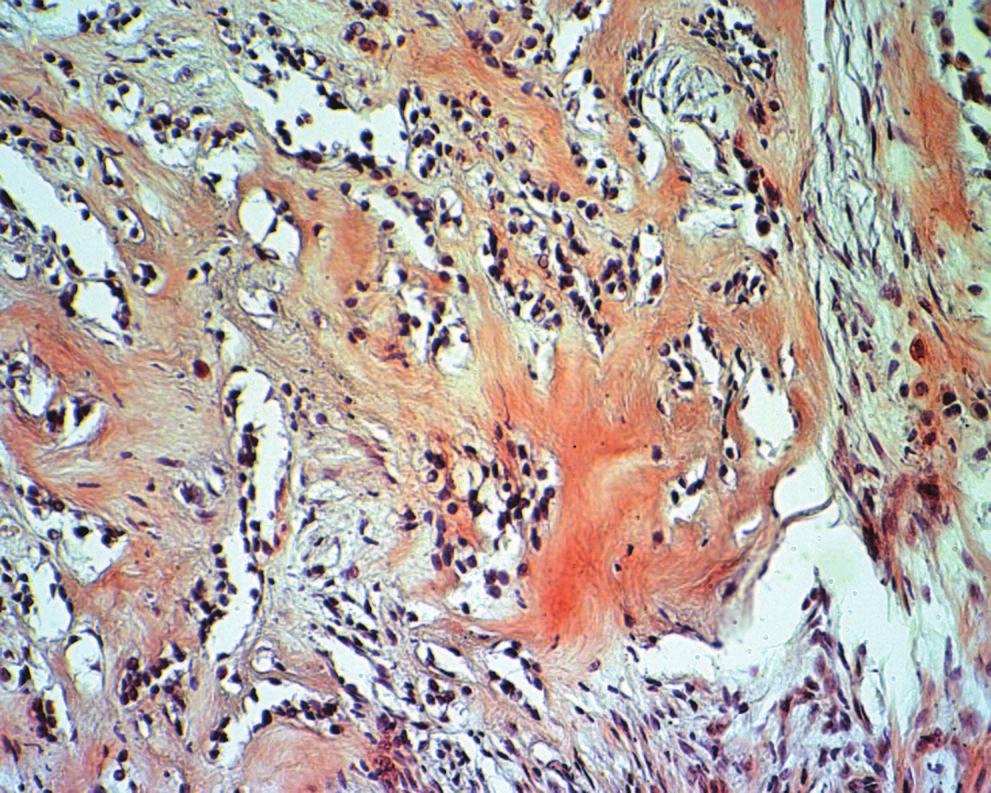117 d e c Figure 3 Histochemicl nd immunohistochemicl spects. Stining ws positive for Congo red stin for the intercellulr eosinophilic mteril (, 3200).