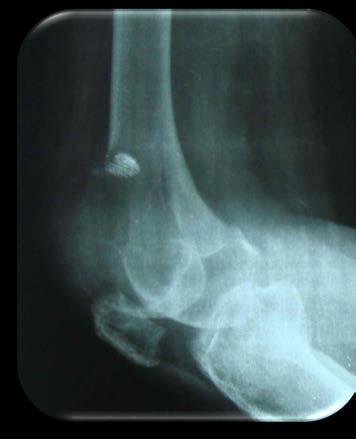 IMAGING Radiographs Eccentric lytic epiphyseal/metaphyseal lesion that often extends into the distal epiphysis and borders subchondral bone "neo-cortex" is