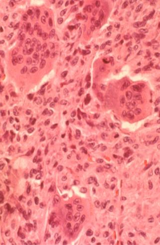 HISTOLOGY Characteristic findings Neoplastic cell is the mononucleur stro mal cell Hallmark giant cells are