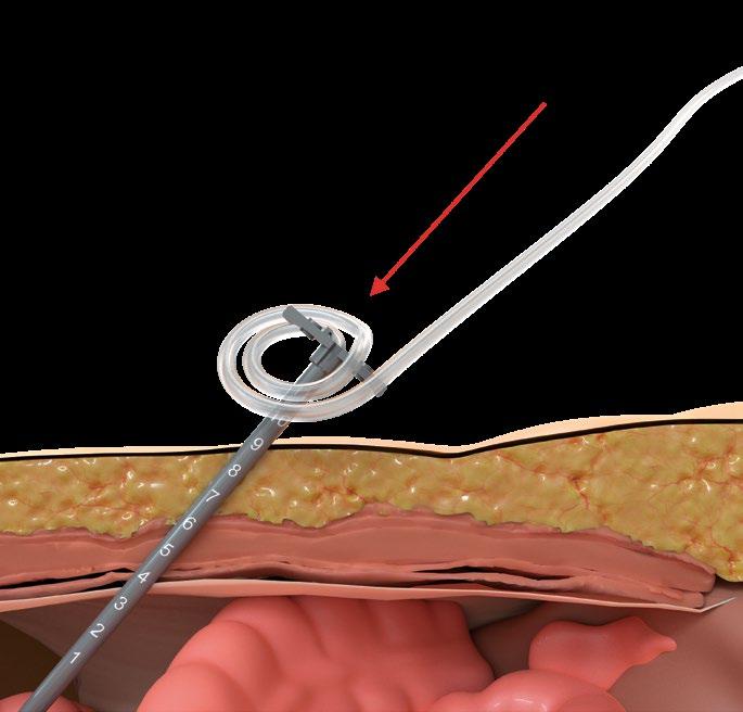 10 (Image 10) Rinse the catheter and the tear away introducer with saline to help reduce friction and then insert the curved tip of the catheter through the