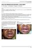 Aloe vera induced oral mucositis: a case report