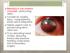 Bleeding in the anterior chamber, obstructing vision Caused by surgery, injury, coagulopathy, sickle cell or idiopathic Needs urgent care to prevent