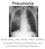 Pneumonia. Mazin Barry, MD, FRCPC, FACP, DTM&H Assistant Professor of Medicine and Consultant Infectious Diseases