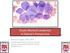 Acute Myeloid Leukemia: A Patient s Perspective