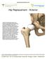 Hip Replacement - Anterior