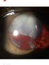 Cataract Complications