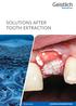 SOLUTIONS AFTER TOOTH EXTRACTION