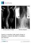 Supine to standing Cobb angle change in idiopathic scoliosis: the effect of endplate pre-selection