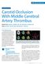 Carotid Occlusion With Middle Cerebral Artery Thrombus