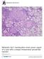 Melanotic Xp11 translocation renal cancer: report of a case with a unique intratumoral sarcoid-like reaction. Ritterhouse et al.