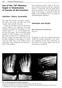 Use of the 20 Memory Staple in Osteotomies of Fusions of the Forefoot