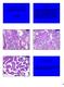 CASE 1A DIAGNOSIS. Problems in the Evaluation of Surface Epithelial-Stromal Tumors of the Ovary: an Update