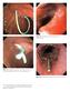 (a) (b) Plate 16.1 Esophageal tear after passage of the echoendoscope.
