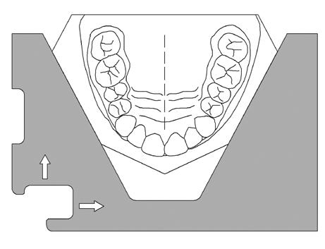 The limit stop for grinding the various base edges is positioned by a precise locking device (Fig. 5). Orthodontic Template for the Upper Jaw (Item no.