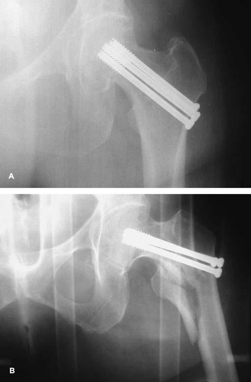 Number 443 February 2006 Apex-distal Screw Configuration for Femoral Neck Fractures 303 Fig 2A B. These illustrations show the (A) apex-distal and (B) apex-proximal screw orientations. Fig 1A B.