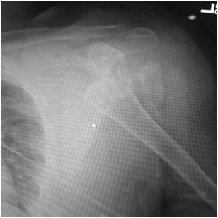 abrasion over the proximal humerus, palpable