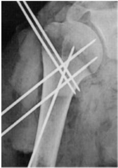 Reduction and Internal Fixation Percutaneous or limited fixation