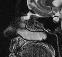 cephalocele ENB MRI warranted