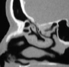 Frontal Sinus and
