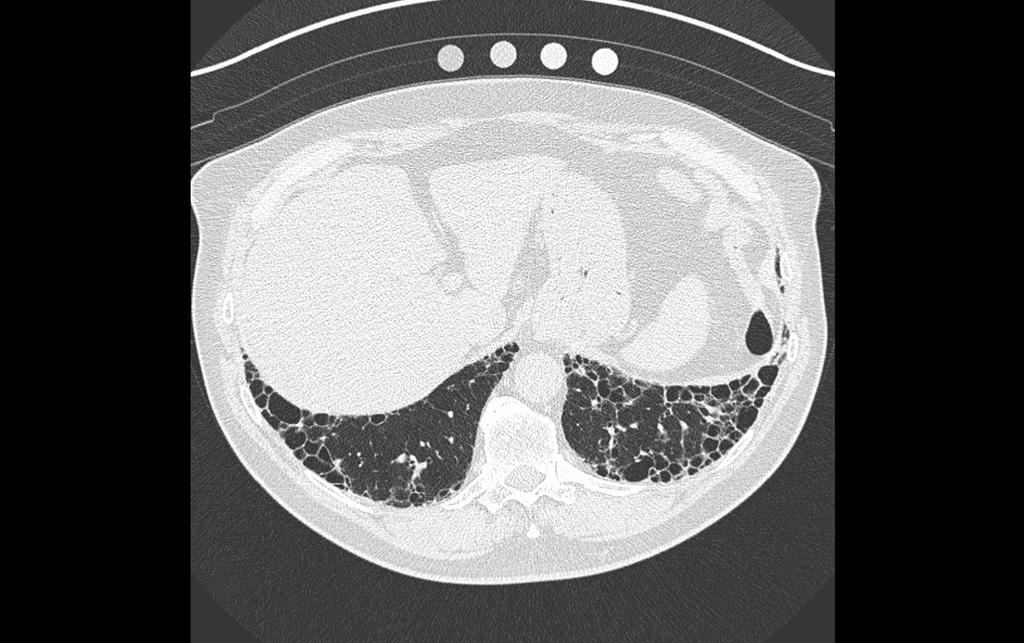 former 25 pack-year smoker, with no significant medical history whatsoever, presents with six months of exertional dyspnea, a dry cough, fatigue and a HRCT scan with a pattern of usual interstitial