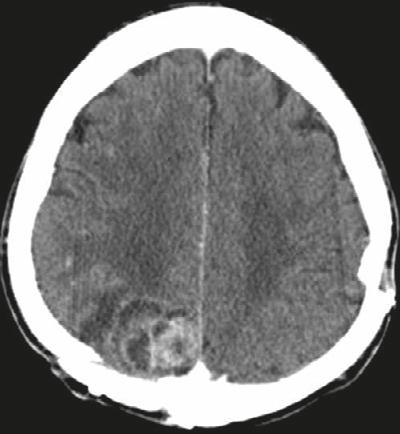 Metastatic brain tumor treated by CyberKnife brain tumors after CyberKnife therapy has been rarely discussed [6].