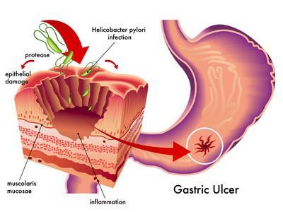 ULCERS Bacterial infections in the stomach and duodenum are associated with ulcers from the bacteria Helicobacter pylori They are tolerant of the low ph of the stomach and eat away and burrow into