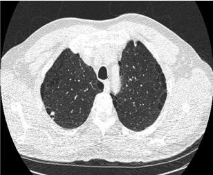 INTEGRATING CT SCREENING FOR LUNG CANCER INTO EVERYDAY PRACTICE: A One Day Intensive Course for Practicing Clinicians Complimentary registration www.mssm.